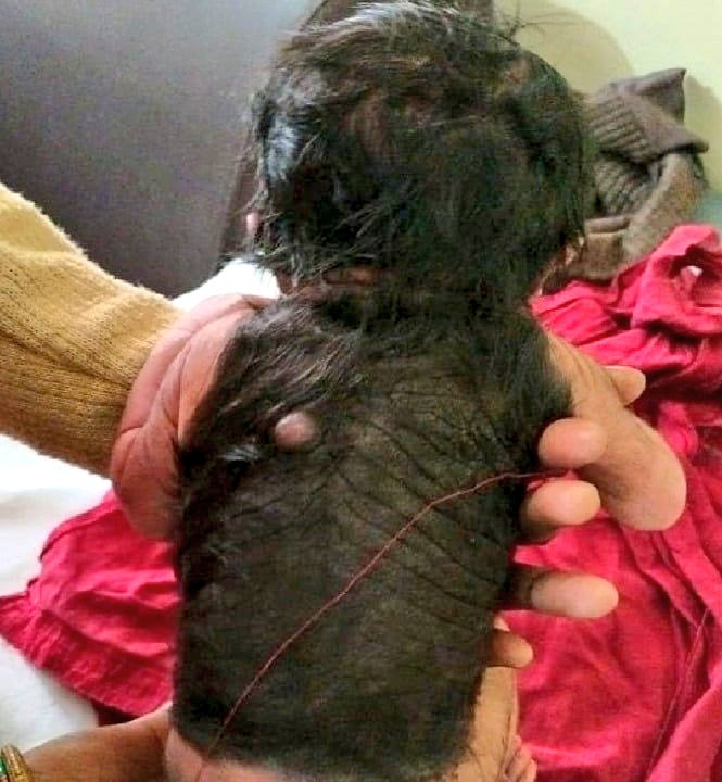 Bebé nace con toda su espalda cubierta de pelos.