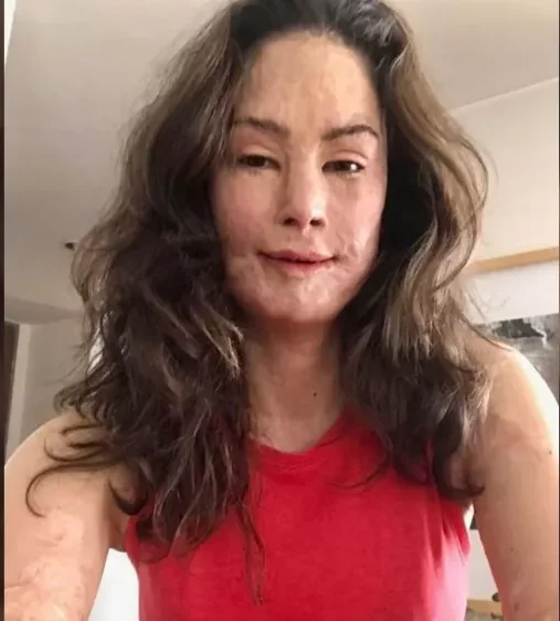 Natalia Ponce, comparte fotos conmovedoras de su vida antes de ser quemada con ácido.