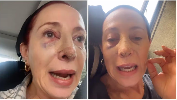 Yaneth Waldman se dio tremendo golpe y quedó con morados en la cara.