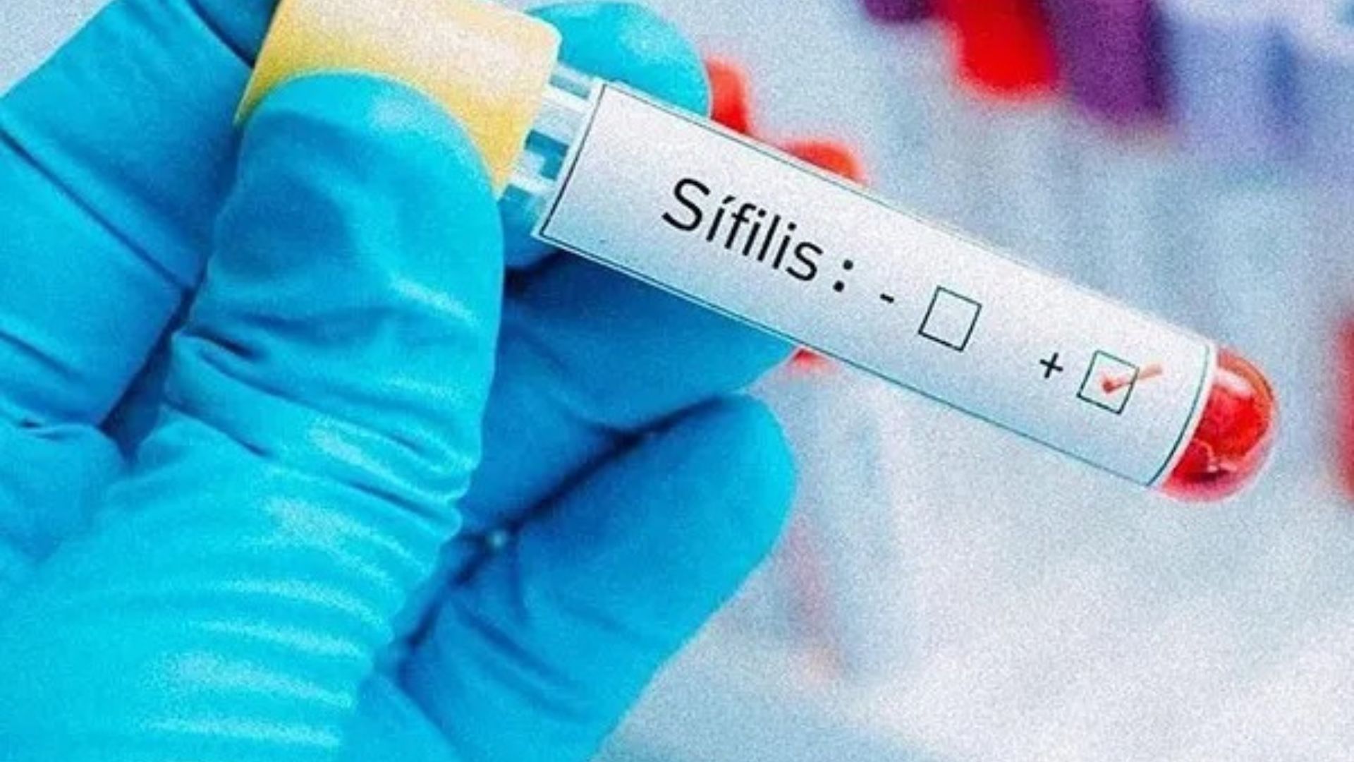 Aumento global de sífilis: La esencialidad del diagnóstico