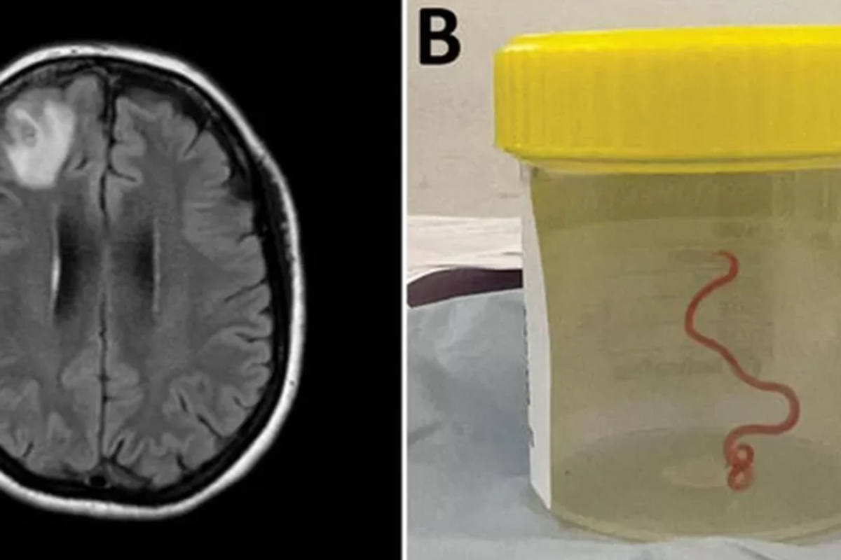 Encuentran larvas en su cerebro tras comer cerdo